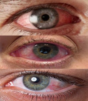 ojos rojos ojos rojos